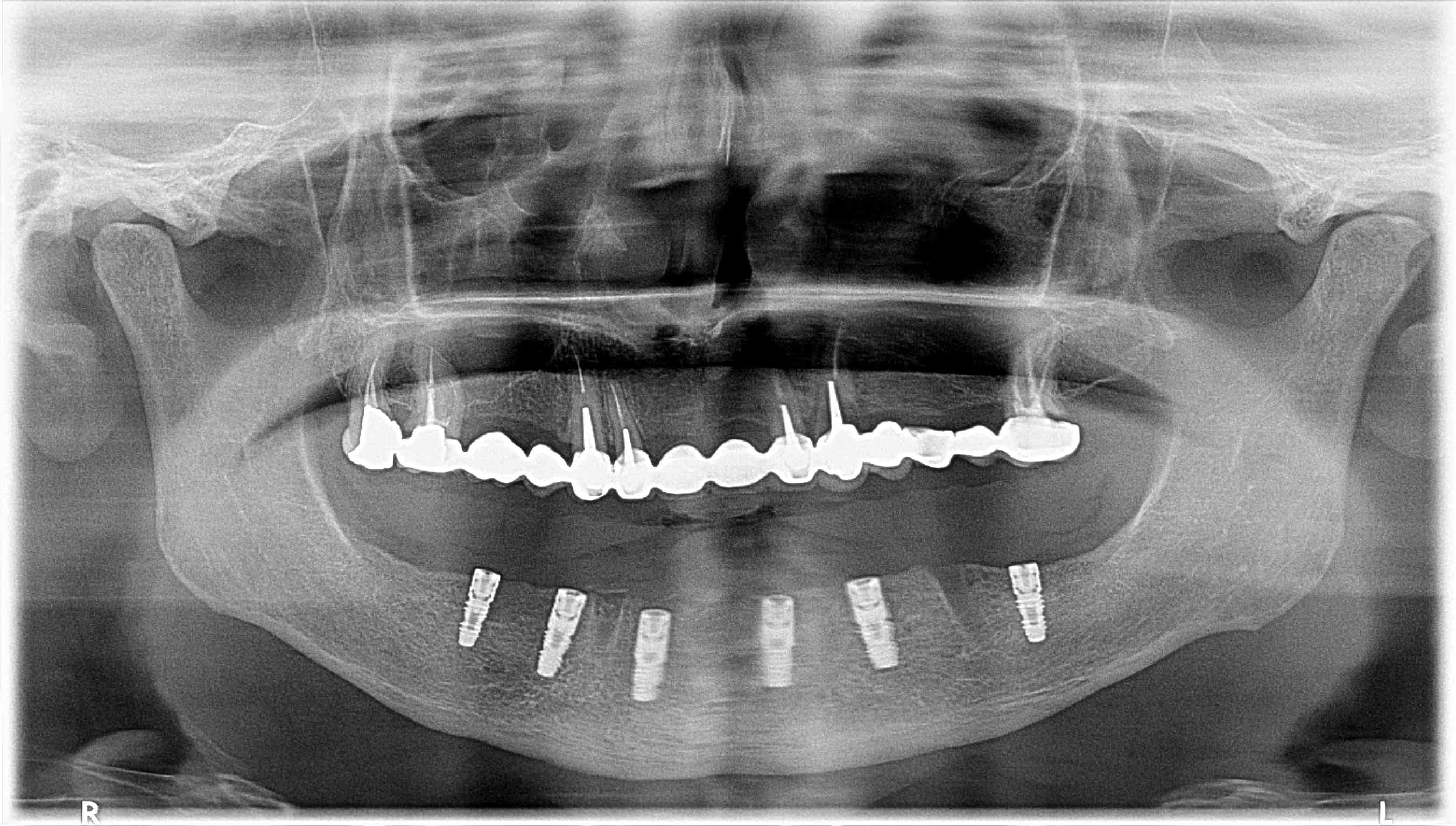 https://clinique-dentaire-solesmes.com/wp-content/uploads/2019/11/implants-1.jpg