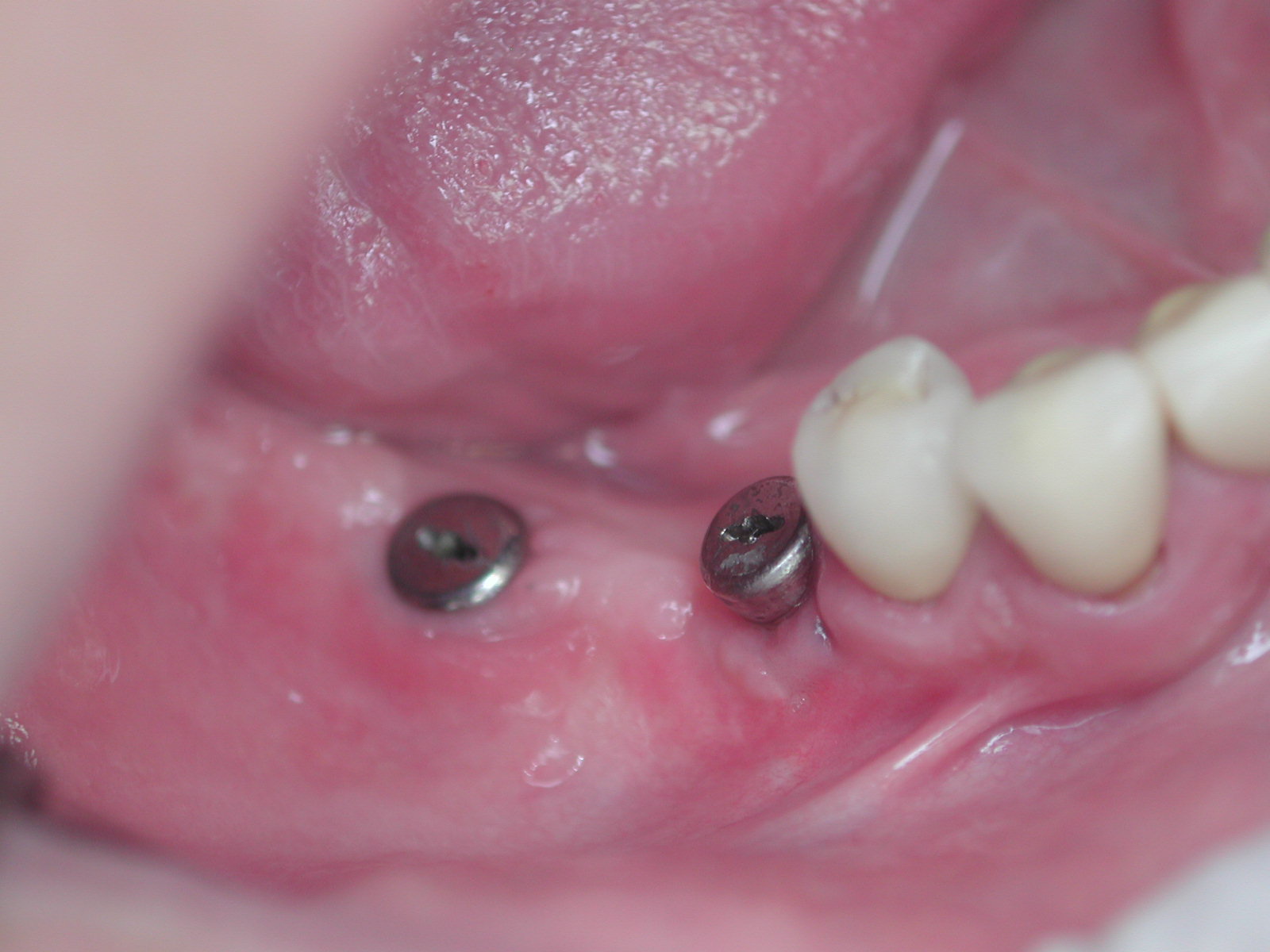 https://clinique-dentaire-solesmes.com/wp-content/uploads/2019/11/implants-16.jpg