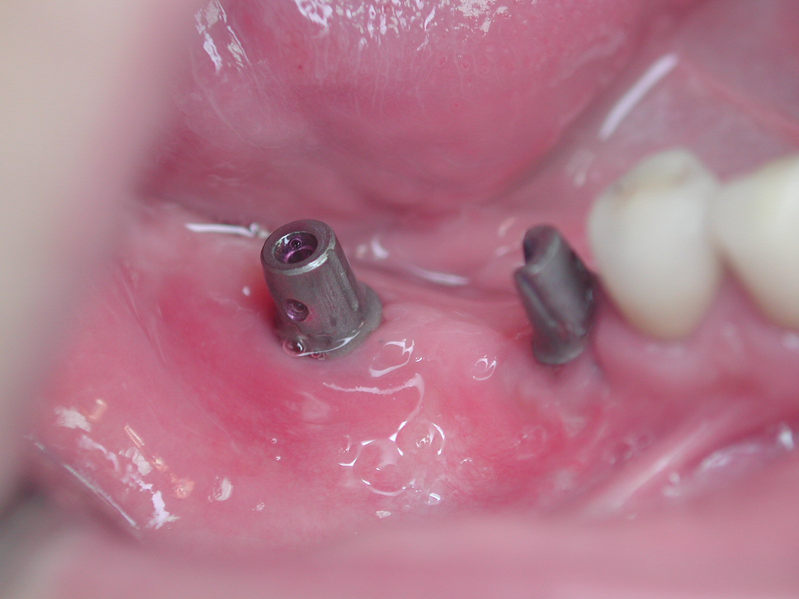https://clinique-dentaire-solesmes.com/wp-content/uploads/2019/11/implants-17.jpg