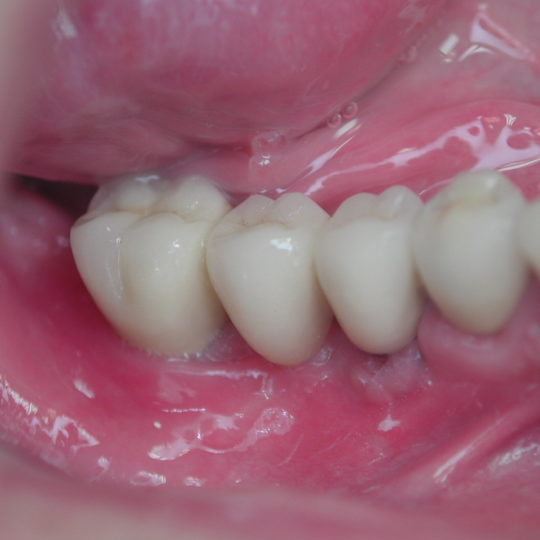 Implantologie dentaire