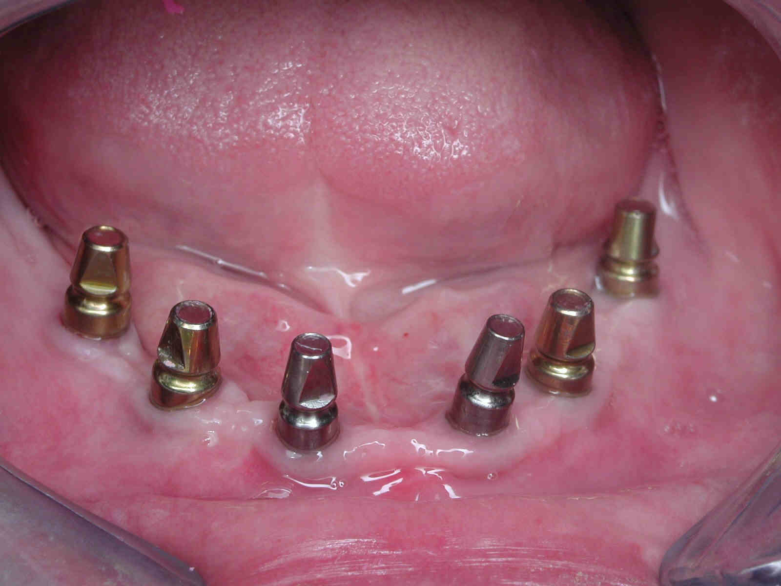 https://clinique-dentaire-solesmes.com/wp-content/uploads/2019/11/implants-2.jpg