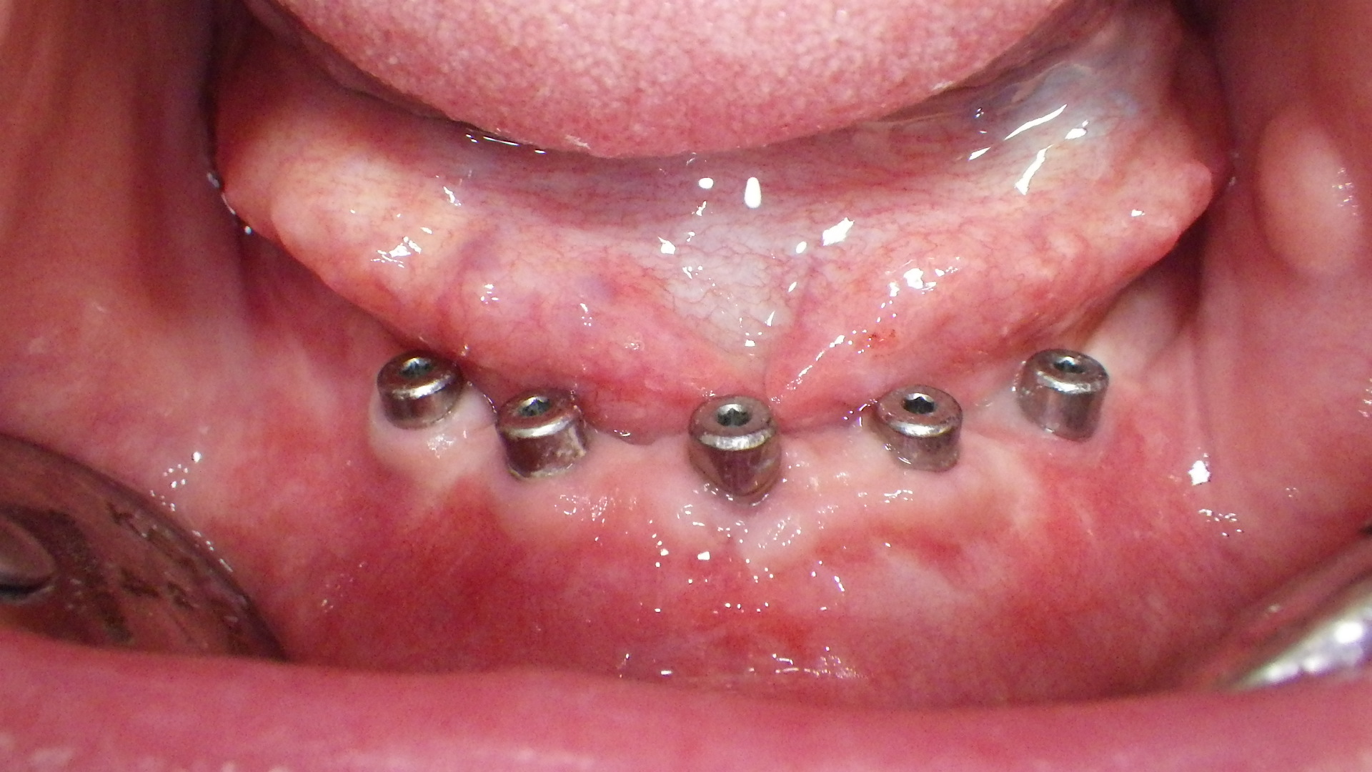 https://clinique-dentaire-solesmes.com/wp-content/uploads/2019/11/implants-4.jpg