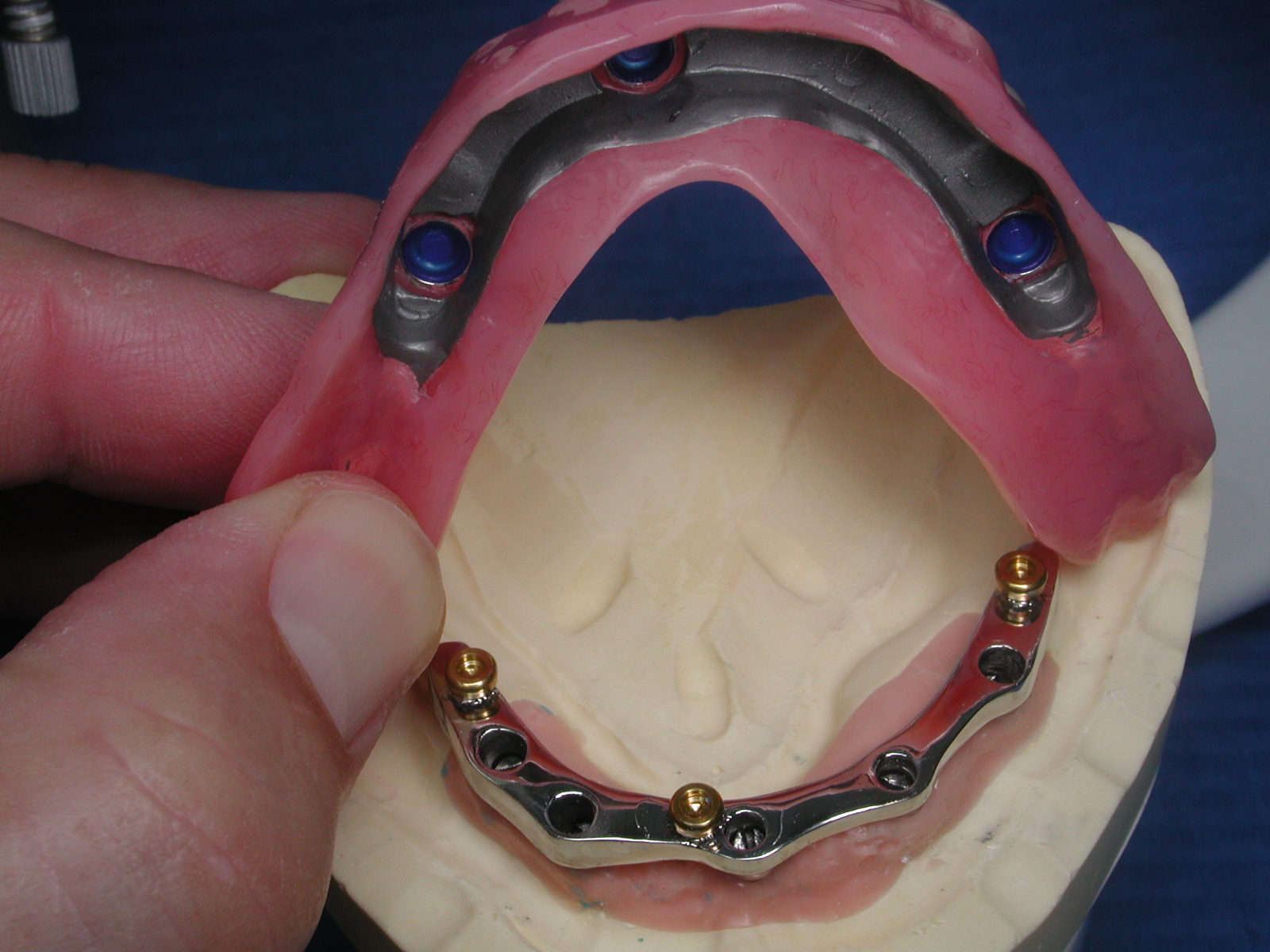 https://clinique-dentaire-solesmes.com/wp-content/uploads/2019/11/stabilisation-prothese-du-bas-2.jpg
